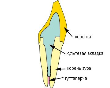 Культевая вкладка зуба. Культевая вкладка на гуттаперчу. Культевая вкладка схема. Культевые вкладки из Риббонда.