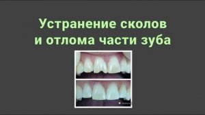 терапевтические виниры и реставрация