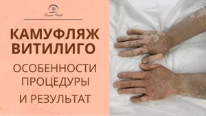 Болезнь Витилиго. КАМУФЛЯЖ ВИТИЛИГО. Особенности процедуры.