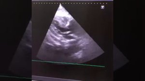 Эхокардиография. Аневризма грудной аорты. Случай из практики.