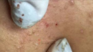 Suri Job 104: BLACKHEADS AND ACNE FIELD