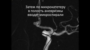 Эмболизация аневризмы ПСА