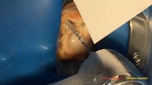 Разборная культевая вкладка / Cast Post.