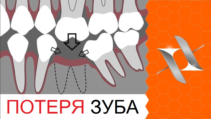 Потеря зуба. Что делать если зубы наклонились. Помогут ли брекеты.