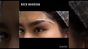 #морщины #красота  #броулифтинг #блефаропластика