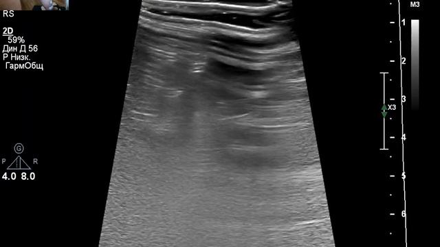 УЗИ вен. Запущенный варикоз. смотреть онлайн