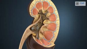 Мочекаменная болезнь  удаление камней и лечение почечной колики 3