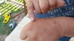 Как правильно удалить пчелиное жало после укуса