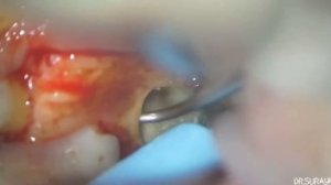 Apical microsurgical , апикальная микрохирургия зуба , удаление кисты зуба , лечение кисты , виниры