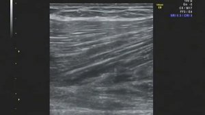 Частичное повреждение мышцы четырехглавой мышцы бедра