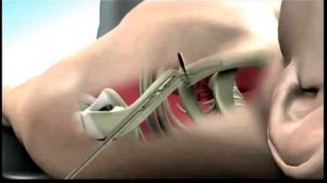 Остеосинтез интрамедуллярным штифтом фирмы SONOMA