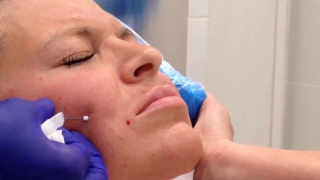 Применение МЕЗОНИТЕЙ Коги (Сog) и Торнадо (Tornado) для подтяжки лица. смотреть онлайн