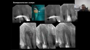 Вебинар №8 - Прикладное применение знаний о антисептике. Ирригация - готовые протоколы.
