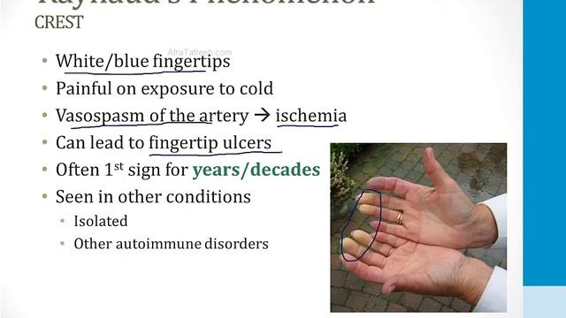 Иммунология USMLE - 4. Аутоиммунные заболевания - 3.Склеродермия