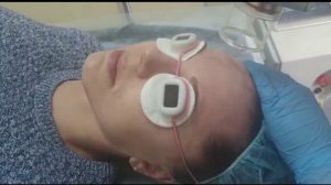 Проведение лазерной шлифовки зоны лица