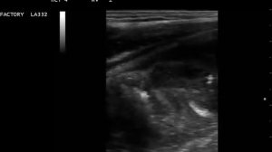 рыхлый аппендикулярный инфильтрат