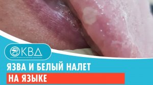 ? Язва и белый налет на языке. Клинический случай №798