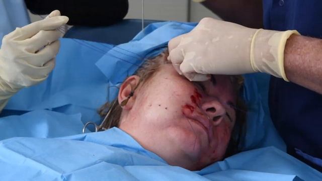 MINT LIFT brows midface x12 V at 1 day смотреть онлайн