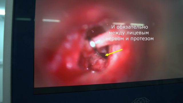 #стапедопластика при тотальной платинэктомии