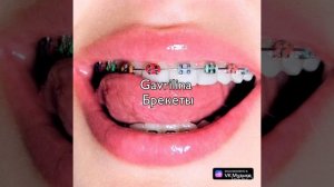 gavrilina брекеты  - speed up