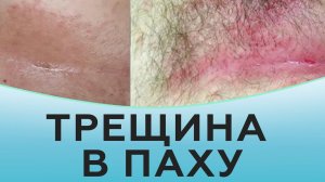 Трещина в паху.