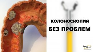 Как делать колоноскопию. Многопрофильная клиника "Скандинавия".How to perform colonoscopy procedure