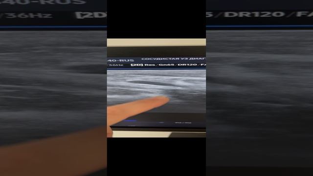 Варикоза нет. Боли в ногах, причина артроз. Узи сосудов. Флеболог Москва. Флеболог. Сосудистый хирур смотреть онлайн