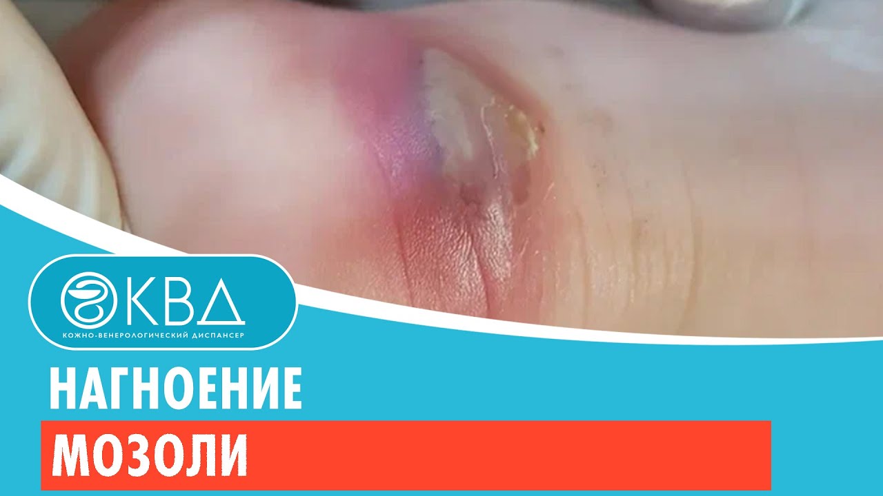 ? Нагноение мозоли. Клинический случай №375