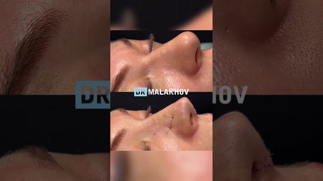 Первичная риносептопластика👀Подробный разбор данного случая в моем ТГ-канале без цензуры📲