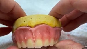 Моделировка съёмного протеза