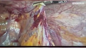 Спайки брюшной полости  Болевая форма и кишечная непроходимость