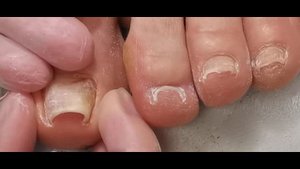 Как поставить тампонаду при вростающих ногтях.