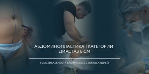 Абдоминопластика с ушиванием диастаза и липосакцией живота