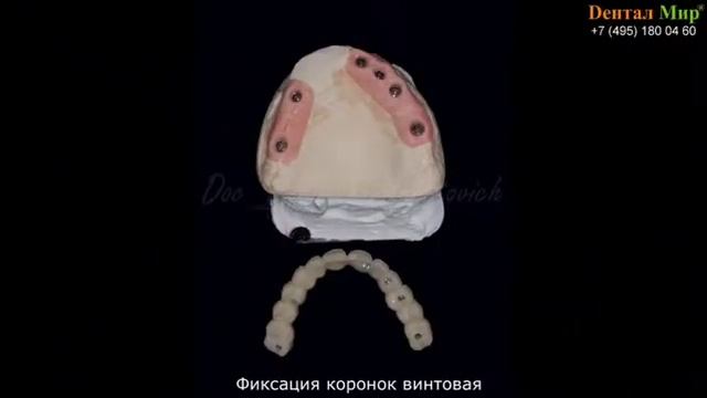 Установка имплантатов, коронки на имплантаты, имплантация после удаления, навигационные шаблоны.