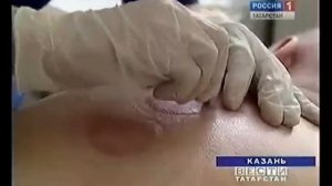 Хиджама, точки хиджамы