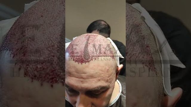 пересадка волос в Emax clinic в Стамбуле #пересадкаволос #волос #турция #dhimethod #россия #украина смотреть онлайн