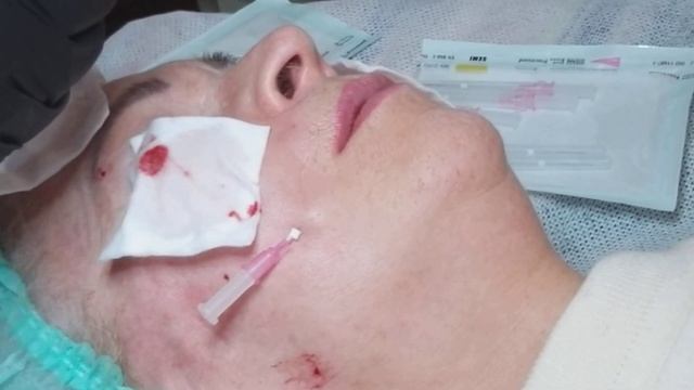 НИТИ SCREW. Носогубная складка /периоральная область. смотреть онлайн