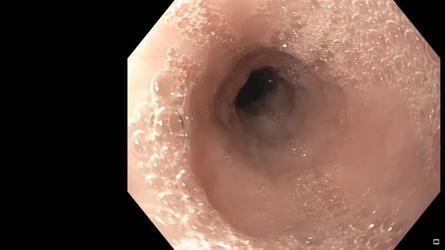 Gastroscopy | OGD | See inside the stomach! смотреть онлайн