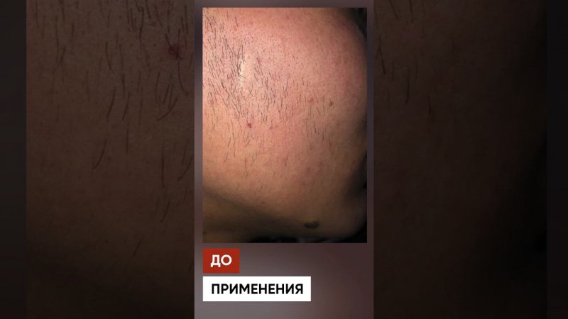 БУСТ ДЛЯ БОРОДЫ. Результат за 3 месяца