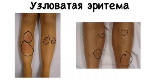 Узловатая эритема. Сыпь. #узловатаяэритема#сыпь#подготовкакusmle