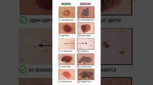 Какие образования на коже ОПАСНЫ и их нельзя трогать