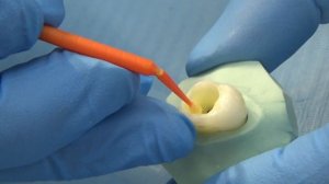 часть 2 . Universal   адгезивные  системы . Техника  селективная  и самопротравливания