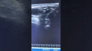 Блокада плечевого сплетения с применением УЗИ навигации.