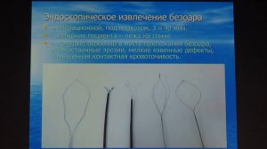11 Мечёва ЛВ – Эндоскопическое удаление крупного безоара желудка у пациента с тяжелой сердечной пат