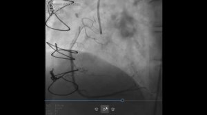 Коронарография, Шунтография, Стентирование 1 ДВ ПМЖВ ЛКА при Нестабильной Стенокардии