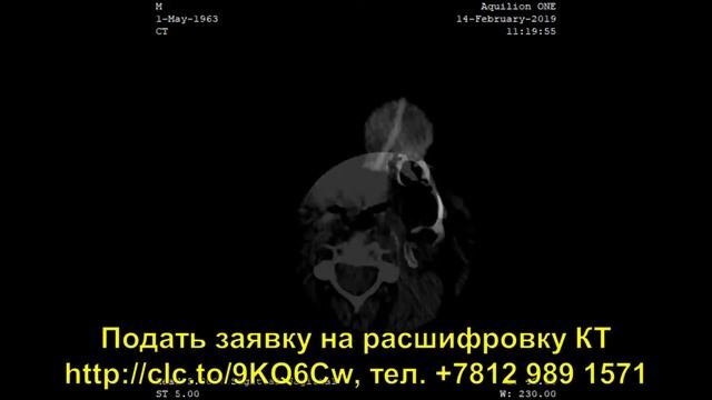 Расшифровка КТ пазух носа - как расшифровать диск КТ