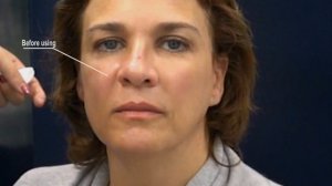 Эффект после процедуры RF-лифтинга аппаратом ReadySkin nanoSkin