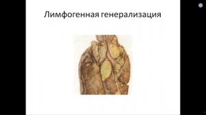 Патанатомия. Лекция 10. Туберкулёз. ДМН, проф. Кирьянов Н.А. 08.04.2020