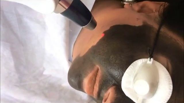 Карбоновый пилинг (процедура), Ереван / Carbon peeling, Yerevan - Liana Pro смотреть онлайн