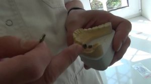 Индивидуальный абатмент